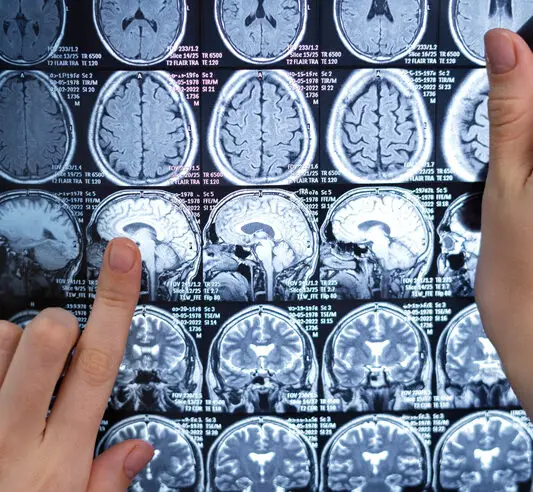 Neurocirurgião esclarece dúvidas sobre tumor cerebral