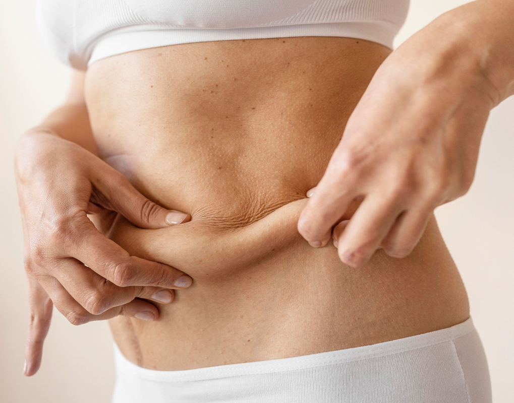 Tecnologia melhora retração da pele após lipoaspiração