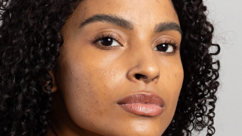 Mês de Conscientização da Acne incentiva cuidados especiais