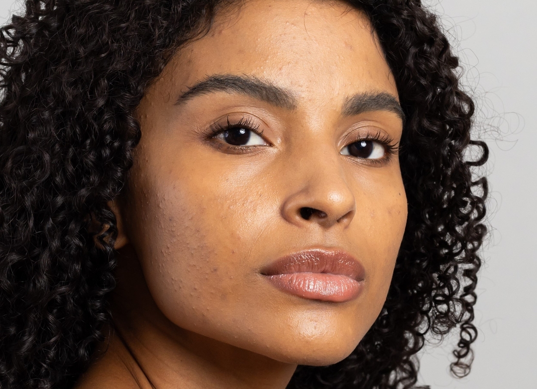 Mês de Conscientização da Acne incentiva cuidados especiais