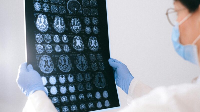 BrainAge: tecnologia indica a idade cerebral