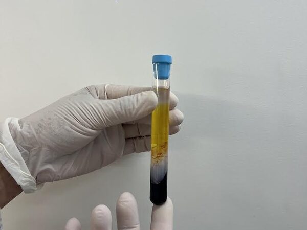 CFM regulamenta PRP em condições osteomusculares