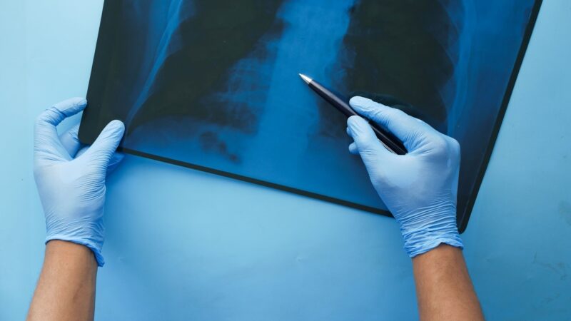 CONITEC abre consulta para Hipertensão Arterial Pulmonar
