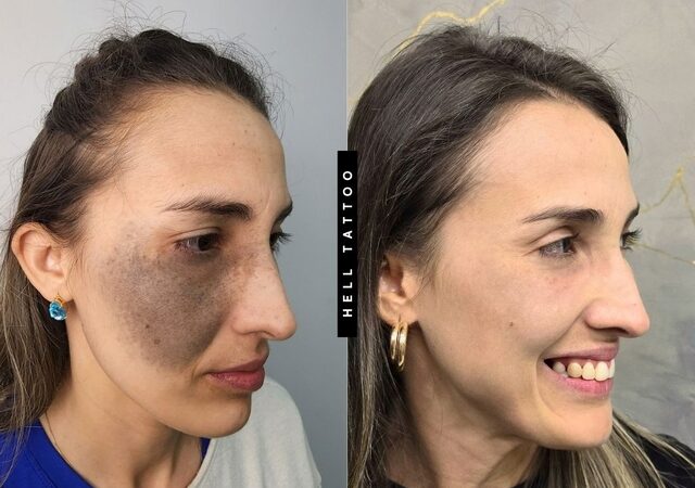 Nevo de Ota pode ser tratado com laser, explica biomédico