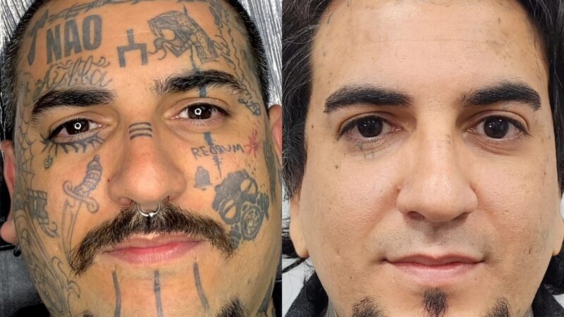 Remoção de tatuagem cresce e muda perfil de quem procura